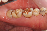 代々木の歯医者で自家歯牙移植